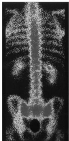 Ejemplo de gammagrafía de la columna vertebral